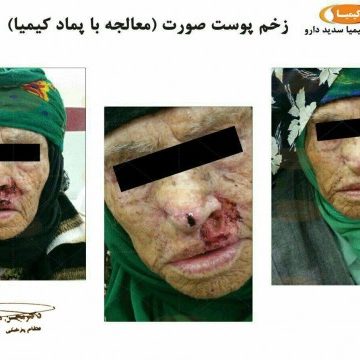 زخم پوست صورت زخم پوست صورت