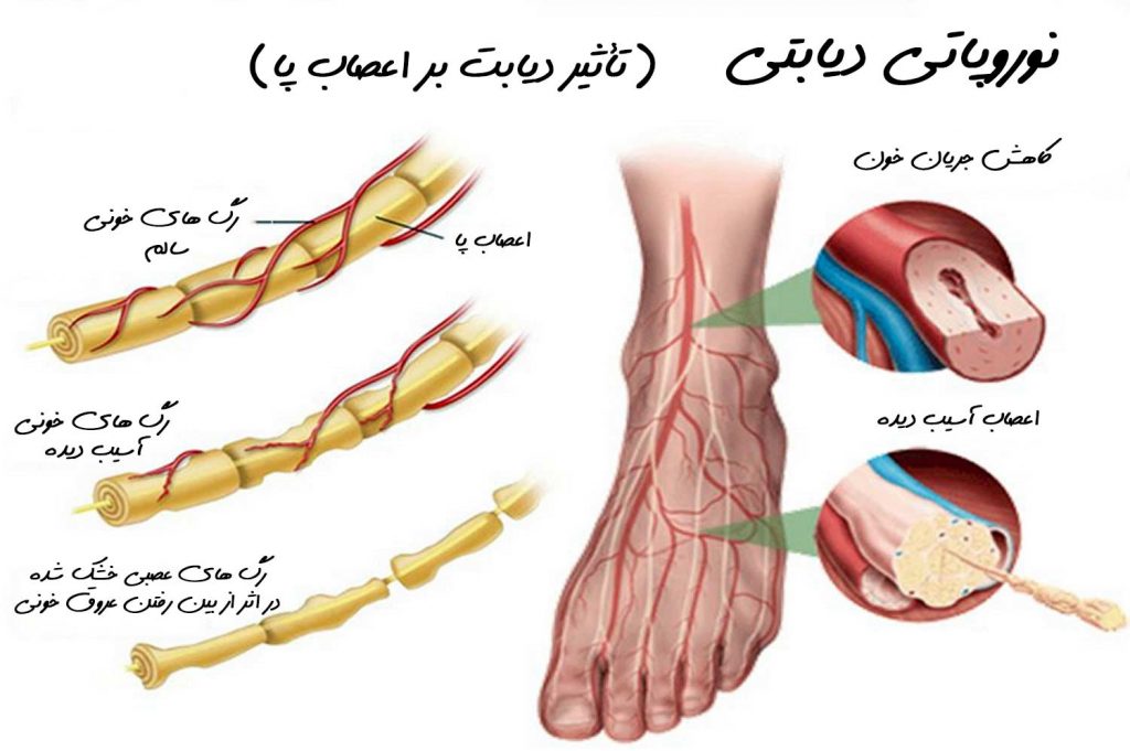 نوروپاتی دیابتی