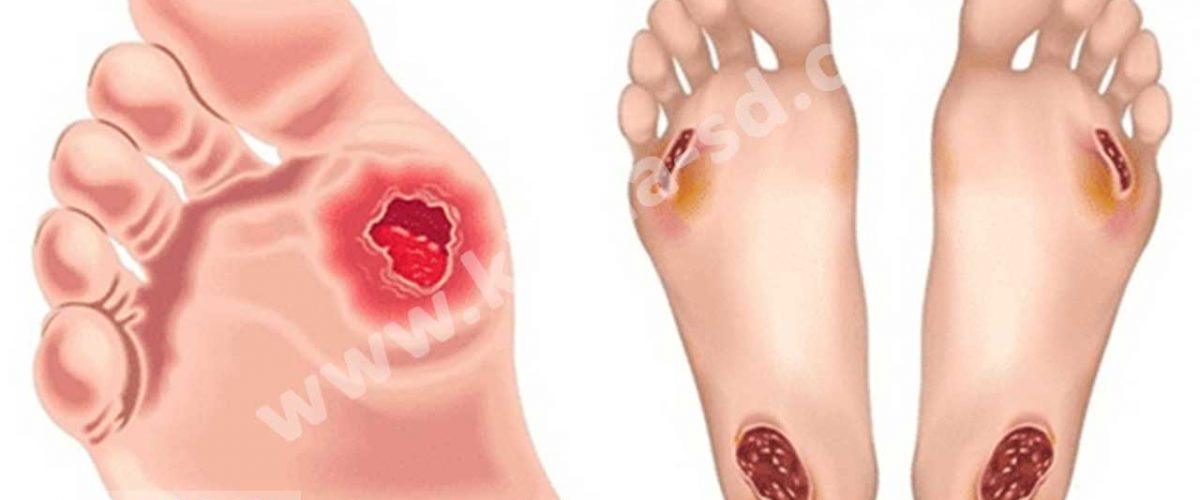 بهبود زخم دیابت با پماد عسل کیمیا