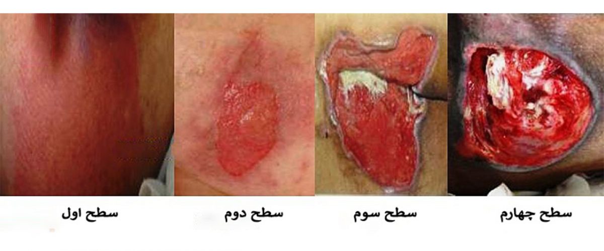 رهایی از زخم بستر با بهترین پماد
