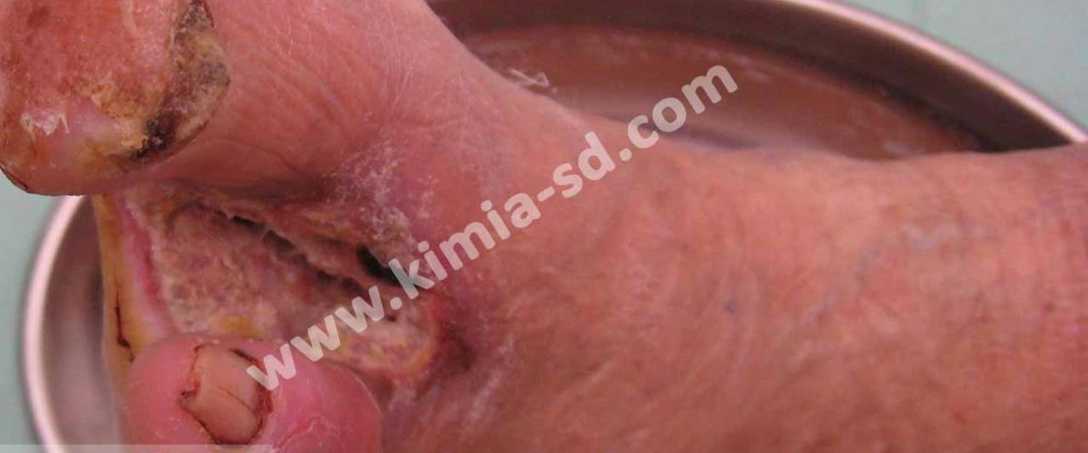 علل و انواع زخم های دیابت