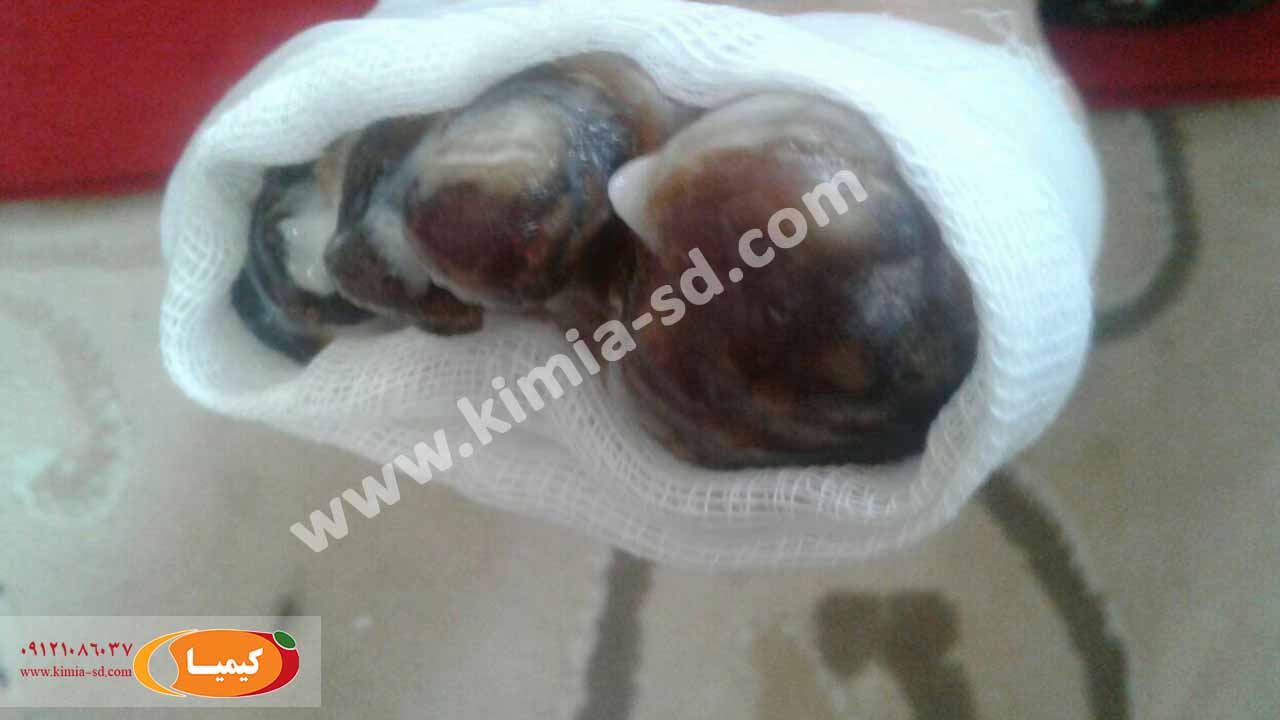 روند درمان زخم دیابت با پماد کیمیا
