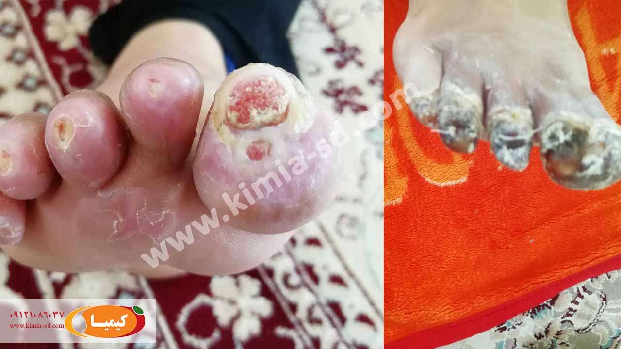 شروع درمان زخم دیابت با پماد کیمیا