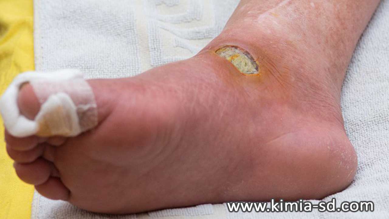 راهنمای پیشگیری از زخم بسترو درمان زخم بستر - پماد کیمیا