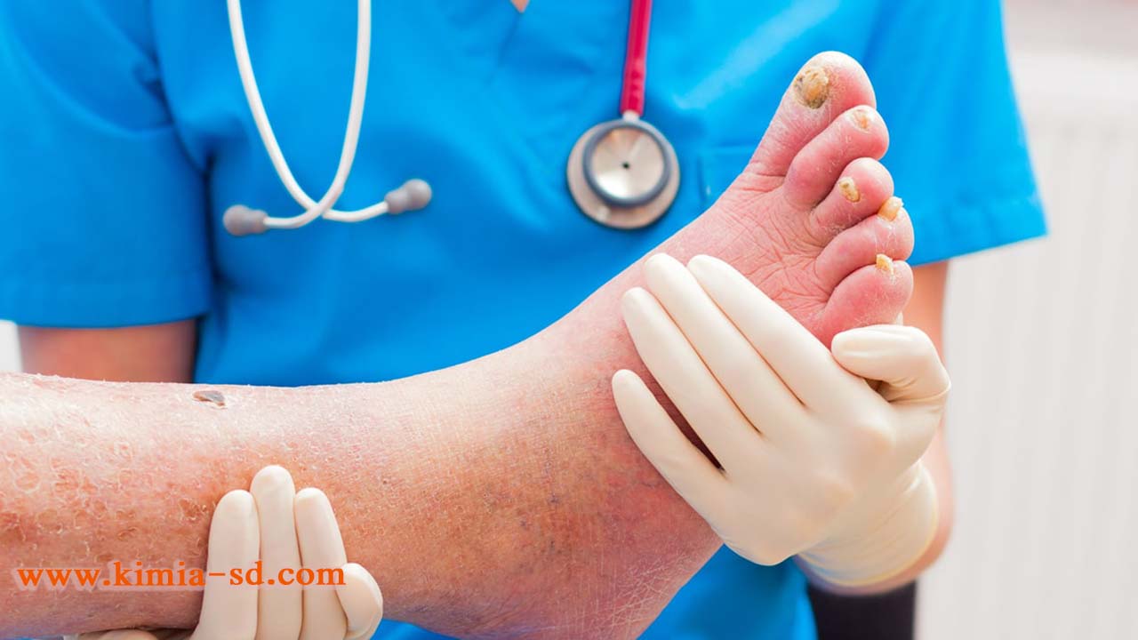 علت درد پا و درمان زخم دیابت- پماد عسل کیمیا