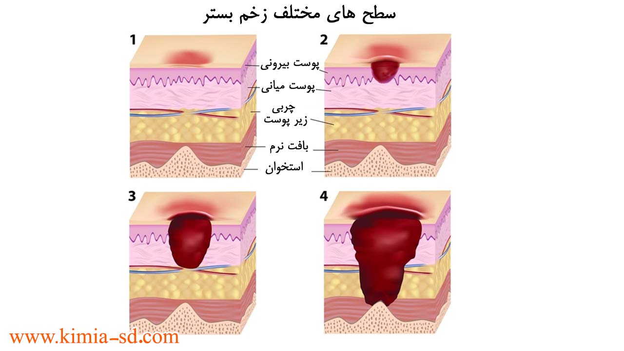 درمان زخم بستر در سطح‌های مختلف